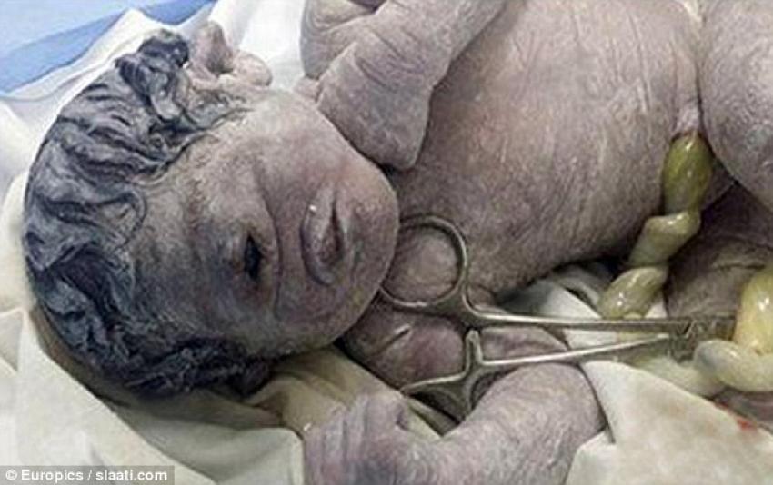 39cyclopia-baby.jpg